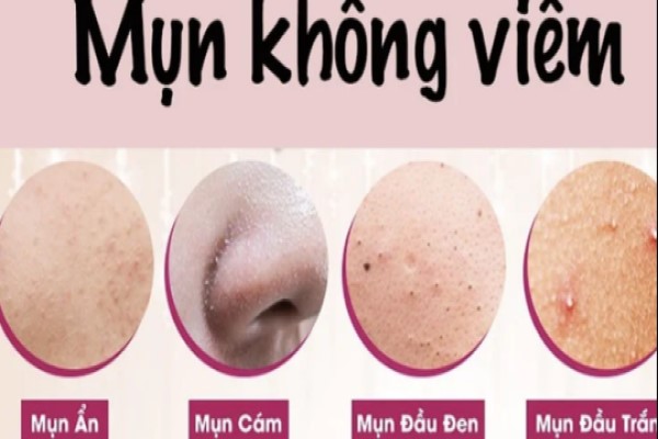 Các loại mụn trên mặt phổ biến cách ngăn ngừa hiệu quả