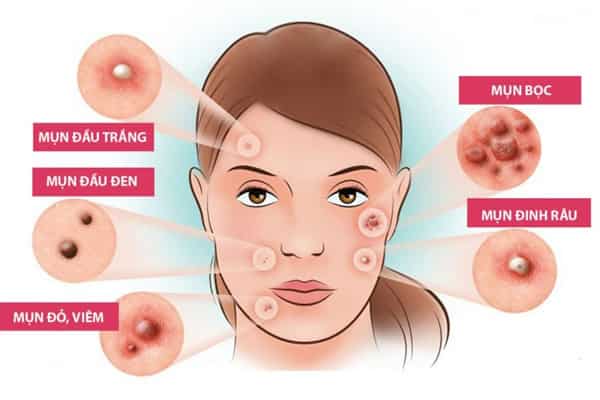 Bí quyết cách trị mụn bằng nguyên liệu thiên nhiên