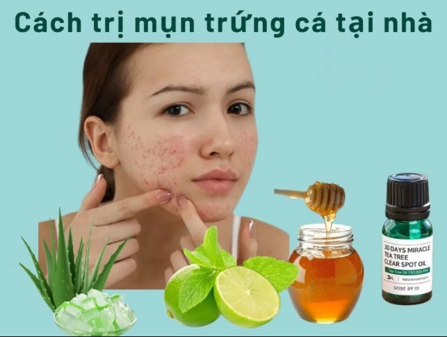 Cách trị mụn tại nhà hiệu quả sau 1 đêm